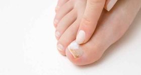 Treatment of toenail fungus or onychomychosis
