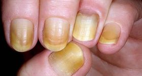 How to avoid yellow nails?