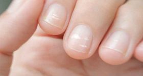 What are the main causes of white spots on the nails?