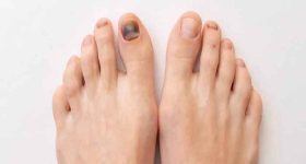 Medical treatments for black toenails